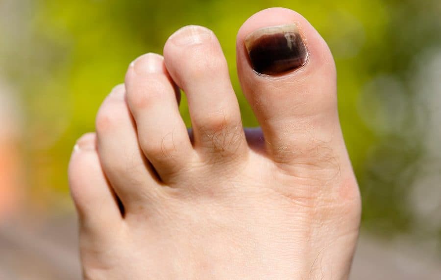 causes-of-black-toenail-how-to-get-rid-of-a-black-toenail-cure-of